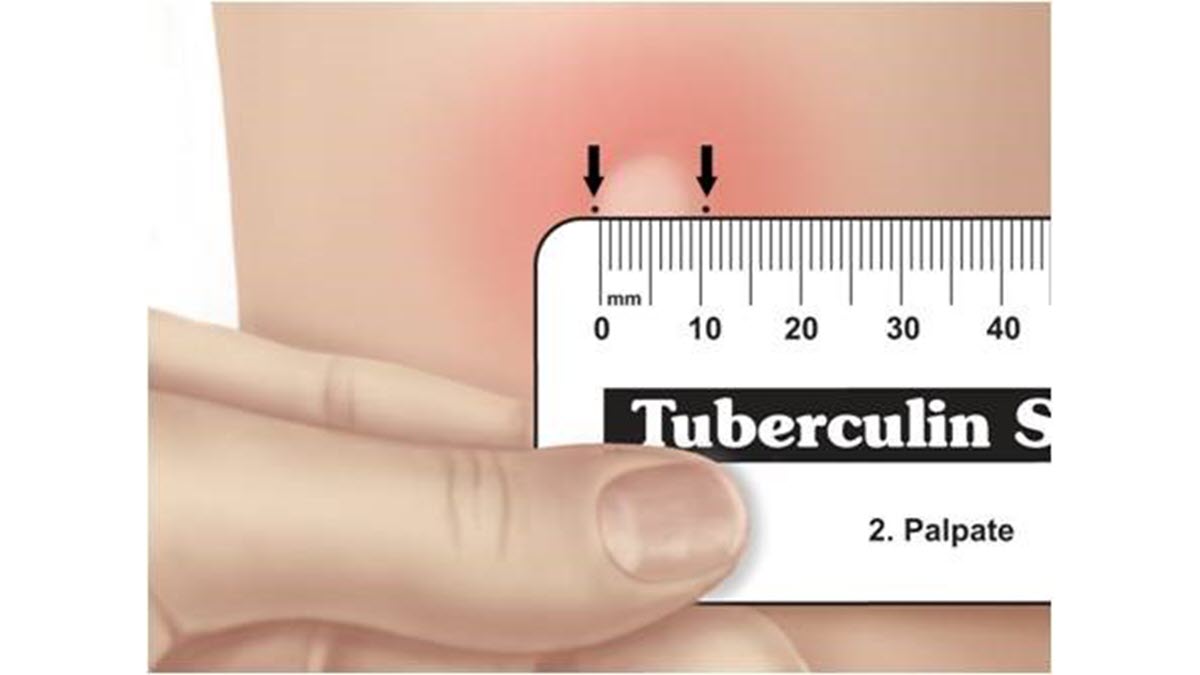 What getting a TB test read looks like graphic